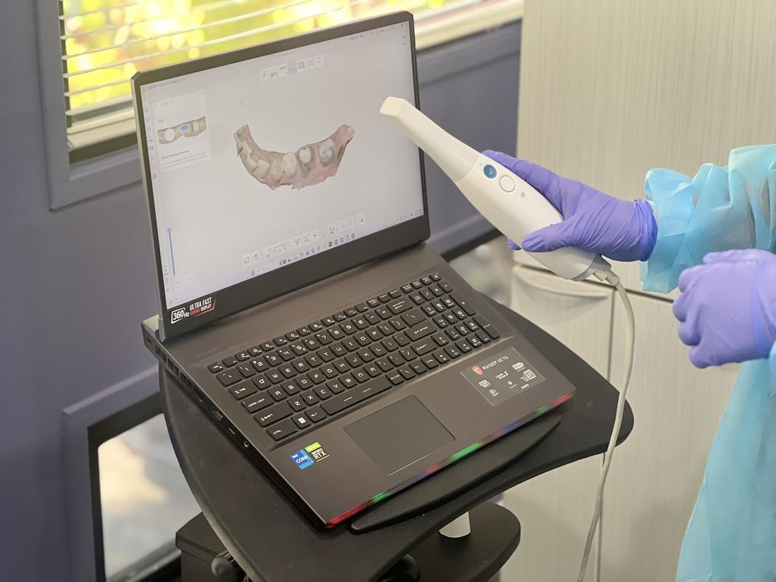 A digital intraoral scan being taken, shown live on screen